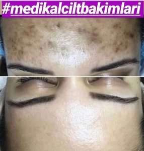 Antalya Medikal Cilt Bakımı