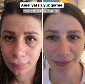 ASya Altuğ Ameliyatsız Yüz Germe