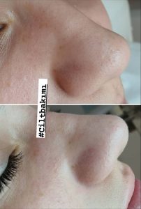 Dermapen Cilt Bakımı
