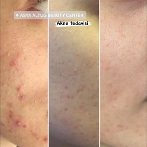 Asya Altuğ Beauty Center - Medikal Cilt Bakımı