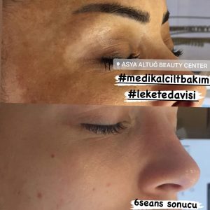 Medikal Cilt Bakımı - Asya Altuğ Beauty Center