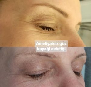Ameliyatsız Göz Çevresi Bakımı Nasıl Yapılır