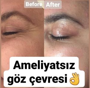 Ameliyatsız Göz Çevresi Bakımları