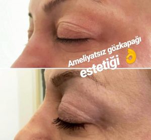 Göz Çevresinde Yaşlanma Neden Olur