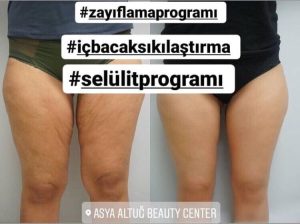 Antalya Bölgesel İncelme - İç Bacak Sıkılaştırma