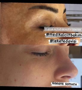 Antalya Cilt Bakımı - Leke Tedavisi