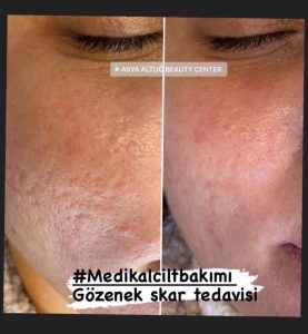 Antalya Cilt Bakımı - Skar Tedavisi